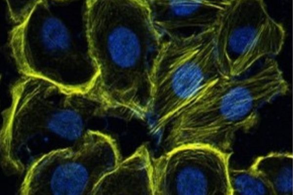 Novel Approach of Using Nanomedicine in Treatment for Breast Cancer Patients with High Mortality Rate