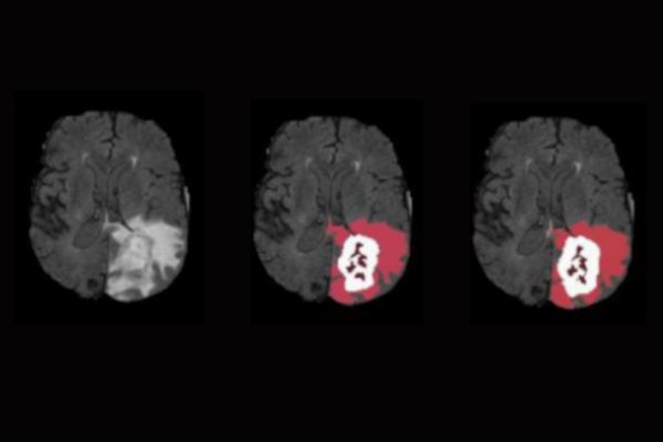 Survival Predictions for Glioma Patients