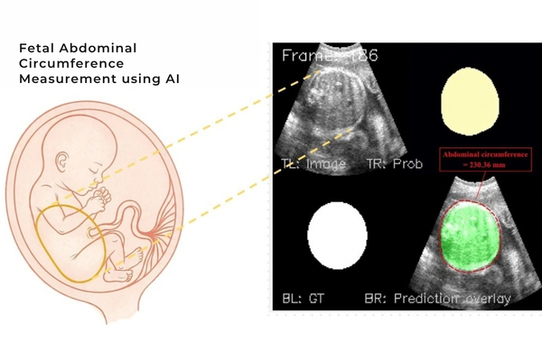 Fetal Growth